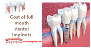 Cost of Full Mouth Dental Implants in 2024