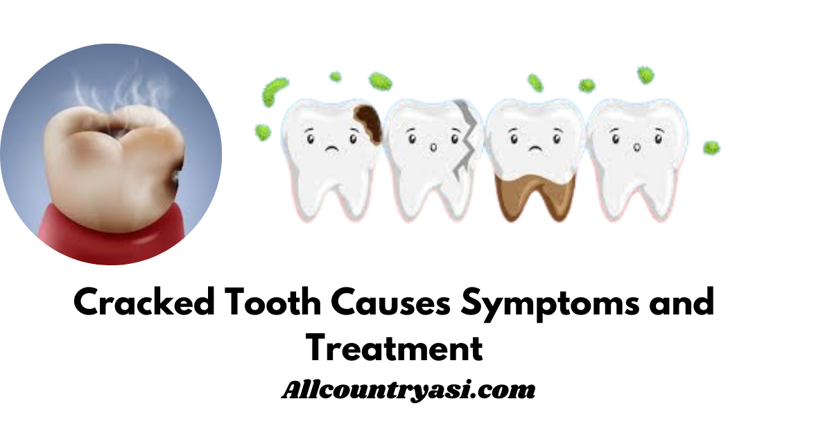 Cracked Tooth Causes Symptoms and Treatment